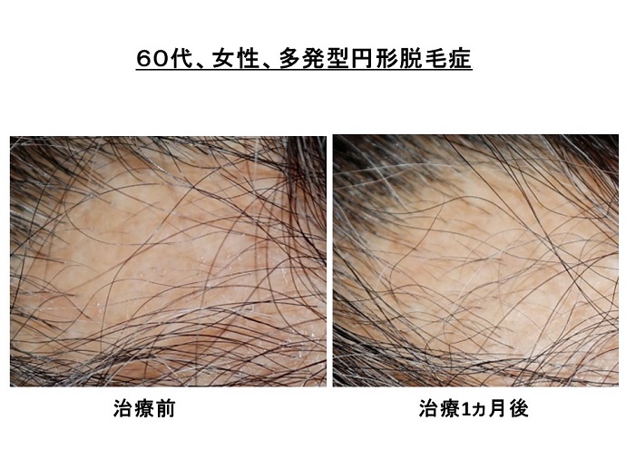 円形脱毛症　病院